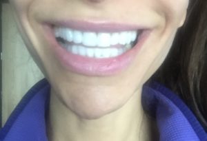 Whitest Teeth Possible No Sensitivity all natural